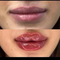 تزریق فیلر|خدمات آرایشگری و زیبایی|الشتر, |دیوار