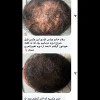 سرم سیر سیاه(قطع ریزش مو تضمینی)|آرایشی، بهداشتی، درمانی|تبریز, |دیوار