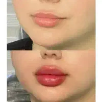 تزریق فیلر و بوتاکس تخصصی ضد تعریق