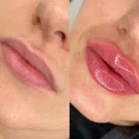 خدمات زیبا صورت تزریق فیلر بوتاکس مزوژل مزونیدلینگ
