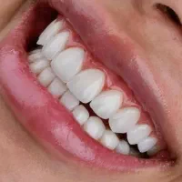 کامپوزیت ونیر