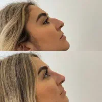 فول فیس ژل لب،گونه،چانه بوتاکس زاویه prp بینی