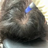 مزوتراپی مو مزونیدلینگ موفقط ۶۵۰ریزش مو رویش مجدد|خدمات آرایشگری و زیبایی|قائم‌شهر, |دیوار