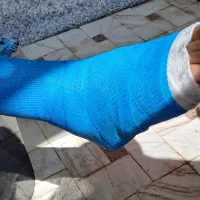 گچ گرفتن و آتل گرفتن توسط کارشناس اتاق عمل|خدمات آرایشگری و زیبایی|قم, پردیسان|دیوار