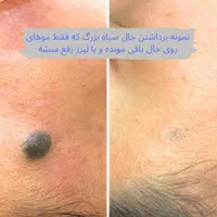 برداشتن خال/زگیل/منگوله های پوستی**|خدمات آرایشگری و زیبایی|اصفهان, مرداویج|دیوار