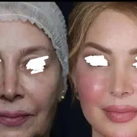 ژل فیلر زیبایی پزشک پوست مو بینی بوتاکس