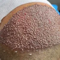 کاشت مو|خدمات آرایشگری و زیبایی|اهواز, نادری|دیوار