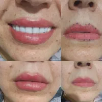 فیلر/ژل/بوتاکس ،بدون درد و کبودی|خدمات آرایشگری و زیبایی|شیراز, مسلم|دیوار