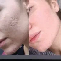 پلاسماجت.درمان نواقص پوستی.پلکسر پلک بینی