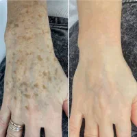 لیزر ، الکترولیز ، روشن سازی ، کک‌ و مک توسط پزشک