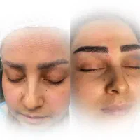 کاشت ابرو اقایان و خانم ها