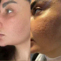 به مدل جهت انجام تکنیک آیینه سازی پوست|خدمات آرایشگری و زیبایی|ورامین, ورامین|دیوار