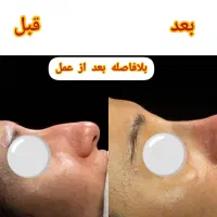 عمل زیبایی بینی|خدمات آرایشگری و زیبایی|زنجان, |دیوار