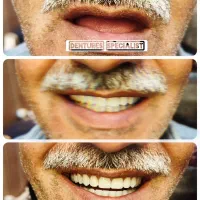 انواع‌ دندان متحرک حرفه ای طرح لمینیت و... باضمانت|خدمات آرایشگری و زیبایی|تهران, ائمه اطهار|دیوار