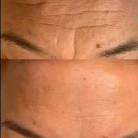 جوانسازی و رفع چین و چروک بصورت ریشه ای|آرایشی، بهداشتی، درمانی|کرج, چمران|دیوار
