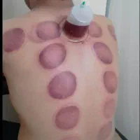 انجام خدمات حجامت زیر نظر پزشک در کلینیک