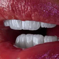 لابراتوار لمینت  روکش زیبایی