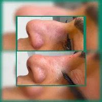 زیبایی نیلگون تخفیف میکروبلیدینگ،فیبروز،فیلر(ژل)