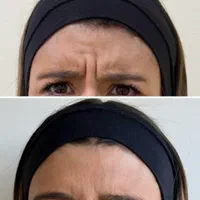 فقط امروز / بوتاکس  /بدون ماسکه شدن صورت/۶۵۰|خدمات آرایشگری و زیبایی|رشت, معلم|دیوار