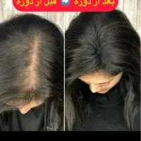 با بهترین قیمت،کاملا طبیعی ریزش مو را کنترل نمایید