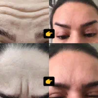 ژل بوتاکس پی از پی مزو فیشال میکرو فیلر بیکنی|خدمات آرایشگری و زیبایی|مشهد, فرهنگیان (شهرک غرب)|دیوار