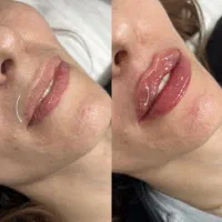 تزریق ژل و بوتاکس در کلینیک