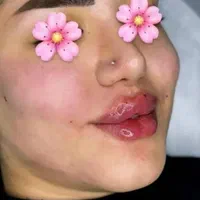 پاکسازی پوست ، ژل و بوتاکس در کلینیک زیبایی|خدمات آرایشگری و زیبایی|اهواز, پادادشهر|دیوار