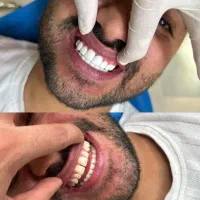 افر ویژه کامپوزیت دندان مواد تضمینی و اصلی|خدمات آرایشگری و زیبایی|کرج, گوهردشت|دیوار