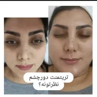 مدل  رایگان  فقط هزینه مواد مزوتراپی وفشیال و تتو|خدمات آرایشگری و زیبایی|فردیس, دهکده|دیوار