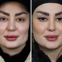 بلفاروپلاستی و خدمات زیبایی پلک VIP