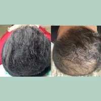 میکرواسکالپ سر