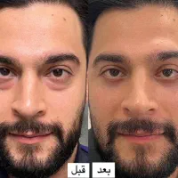 بلفاروپلاستی پلک
