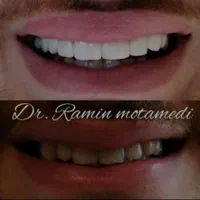 ایمپلنت/کامپوزیت/دندانپزشکی/اقساط|خدمات آرایشگری و زیبایی|شیرگاه, |دیوار