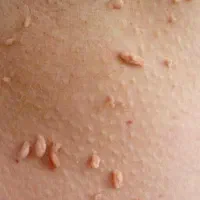 بهبودقطعی وریشه ای زگیل و تبخال تناسلی