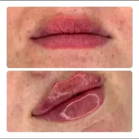 زاویه سازی.ژل.فیلر.نخ.انزیم مزو بوتاکس دکتر داریوش|خدمات زیبایی و سلامت|مشهد, گوهرشاد|دیوار