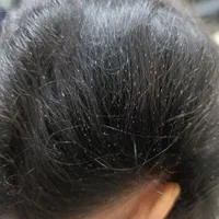 درمان قطعی شپش ورشک دریک جلسه