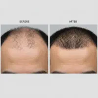 اسکالپ موی سر برای آقایونی که موهای کم پشتی دارند