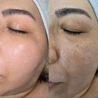 تخفیف ویژه فیشیال تخصصی ،جوانسازی ،اسکراب اسکالپ
