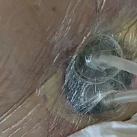 درمان انواع زخم ها با روش های بروز پزشکی|خدمات آرایشگری و زیبایی|تبریز, |دیوار