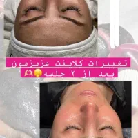 فشیال پوست تقویت مو درمطب پزشک ویژه بانوان وآقایان|خدمات آرایشگری و زیبایی|شیراز, رازی|دیوار