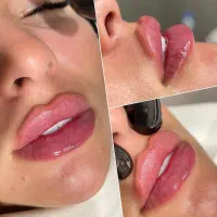 جشنواره بوتاکس و ژل و مزو و چربی و بلفاروپلاستی
