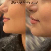 بوتاکس ، فیلر کل صورت ، مزو تراپی ، خال برداری|خدمات آرایشگری و زیبایی|اردبیل, |دیوار