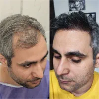 مرکز تخصصی کاشت مو و ابرو احمدیه  اژکان