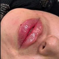 تزریق ژل بوتاکس فیلر