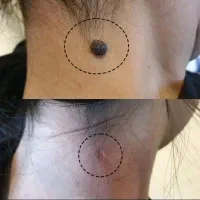 برداشتن خال  کک مک با دستگاه پلاسما