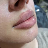 تزریق فیلر و بوتاکس|خدمات آرایشگری و زیبایی|قرچک, مهدیه|دیوار