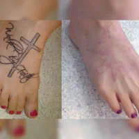 پاک کردن تتو .لیزر.پاککردن خالکوبی .ریموو تتو.prp|خدمات آرایشگری و زیبایی|اصفهان, خلجا|دیوار