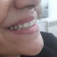 ساخت دندان مصنوعی فلیپر (تک واحدی و دو واحدی)|خدمات آرایشگری و زیبایی|آمل, |دیوار