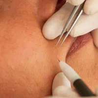 پاکسازی پوست الکترولیز لیزر مو پیرسینگ فیشیال|خدمات آرایشگری و زیبایی|تهران, مرزداران|دیوار