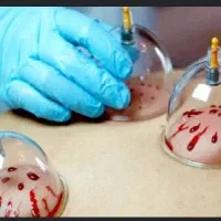 آموزش تخصصی حجامت با مدرک معتبر قابل استعلام